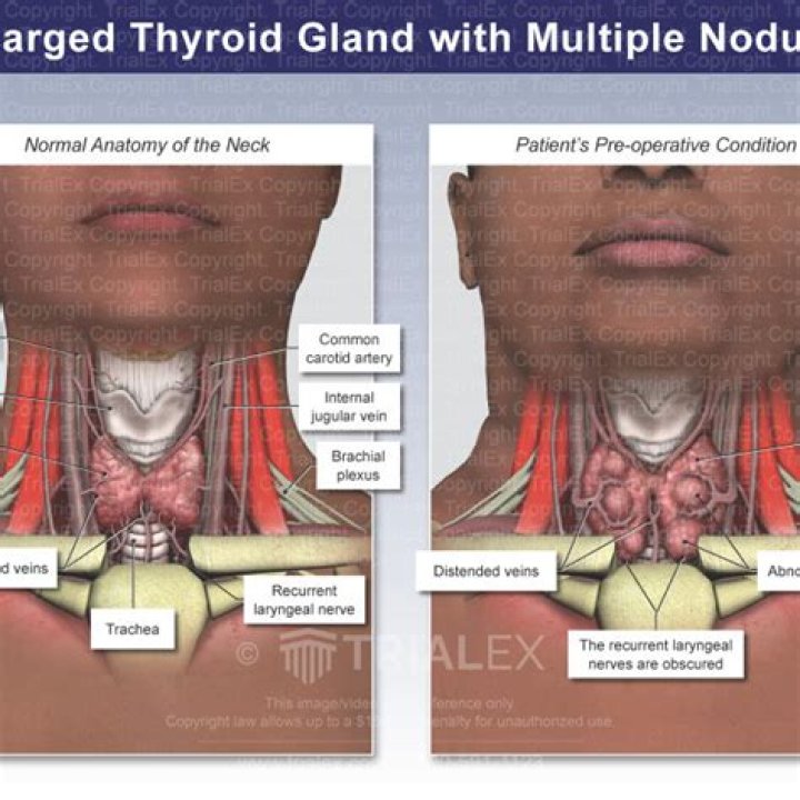 Can a thyroid nodule make your ear hurt?