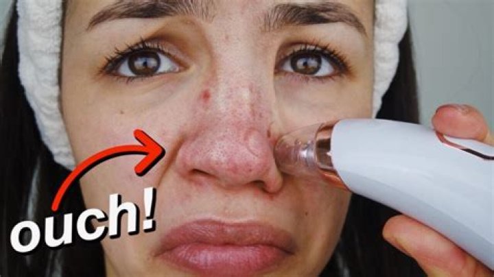 Do blackhead vacuums really work?