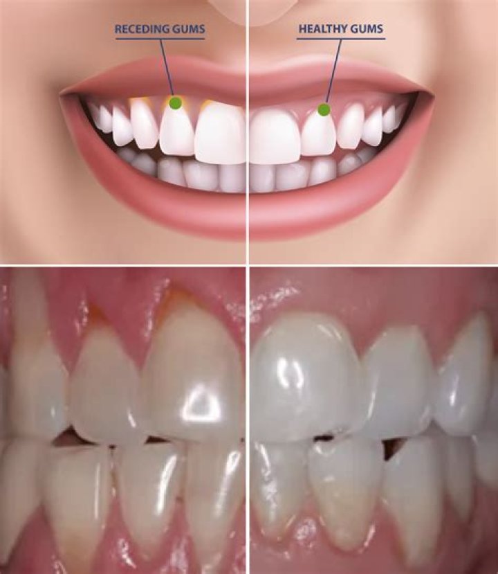 Do your gums bleed in early pregnancy?