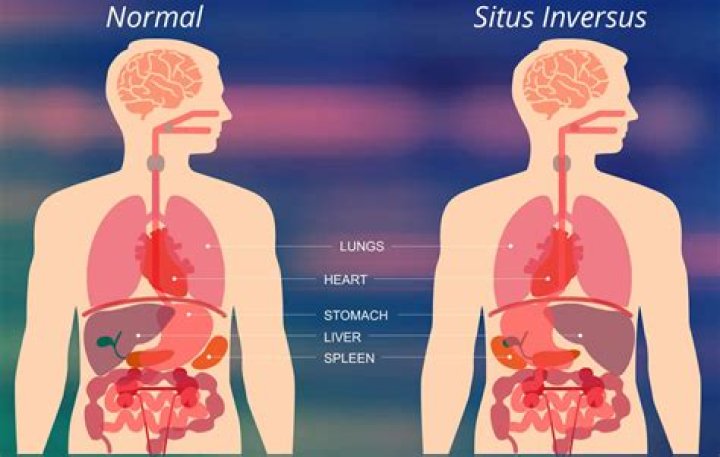 Does Donny Osmond have situs inversus?