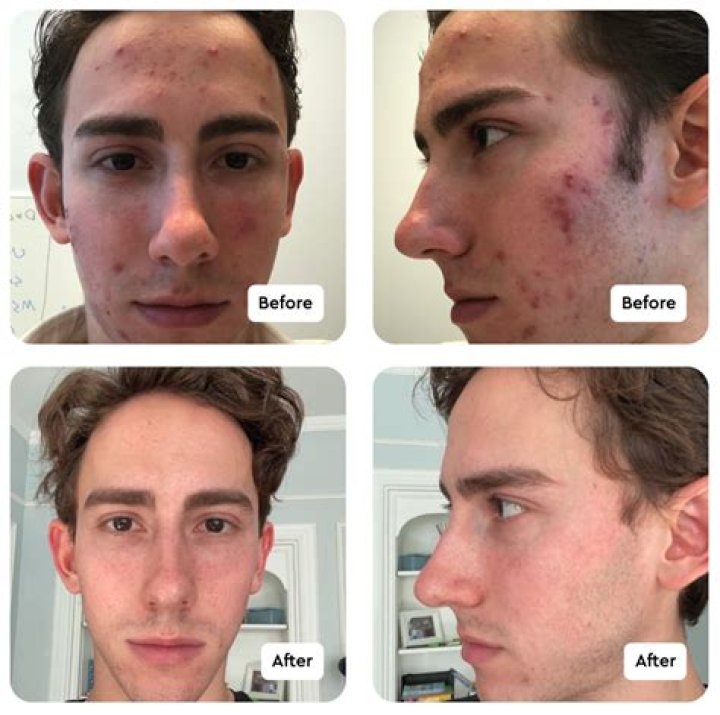 How do you get rid of acne scars on Accutane?