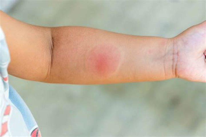 How do you treat a spider bite on a cat?