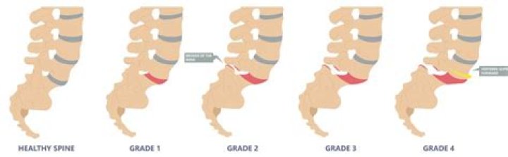 How is Grade 2 Anterolisthesis treated?