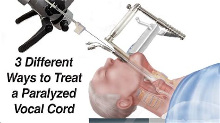 How long do vocal cord injections last?