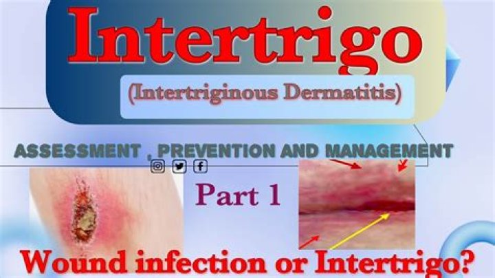 How would you describe intertriginous dermatitis?