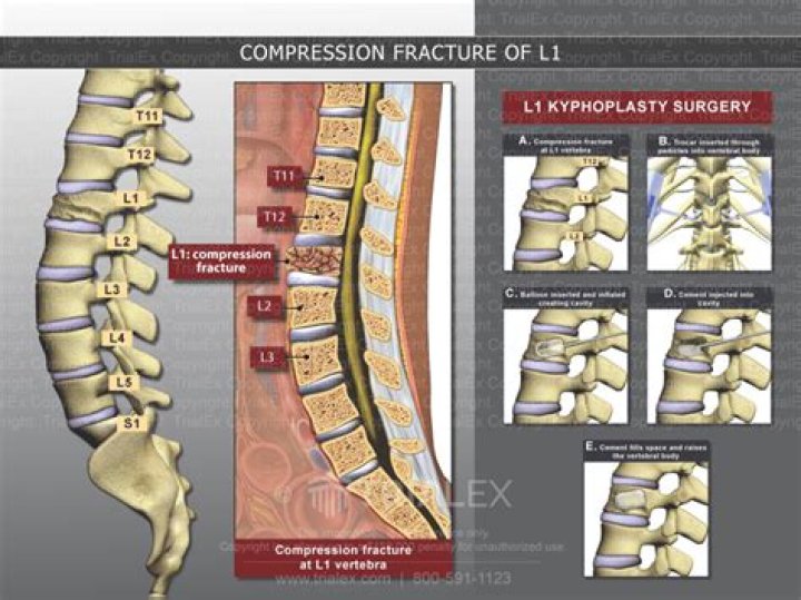 Is a compression fracture considered traumatic?