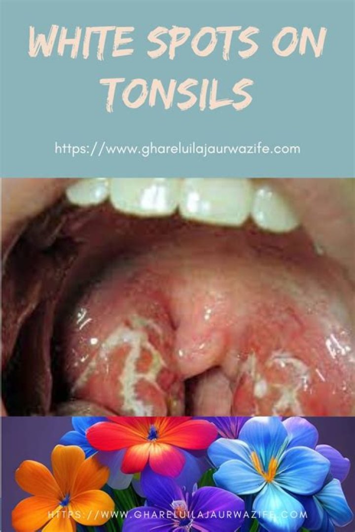 Is it normal to have white lines on tonsils?