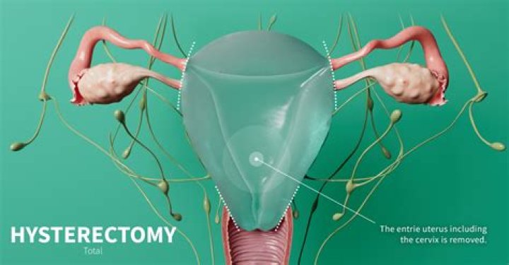Should I get a hysterectomy if I have precancerous cells?