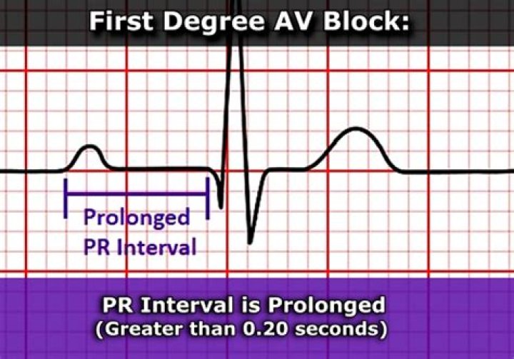 What is a 1st degree AV block on ECG?