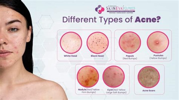 What is acne the creme?