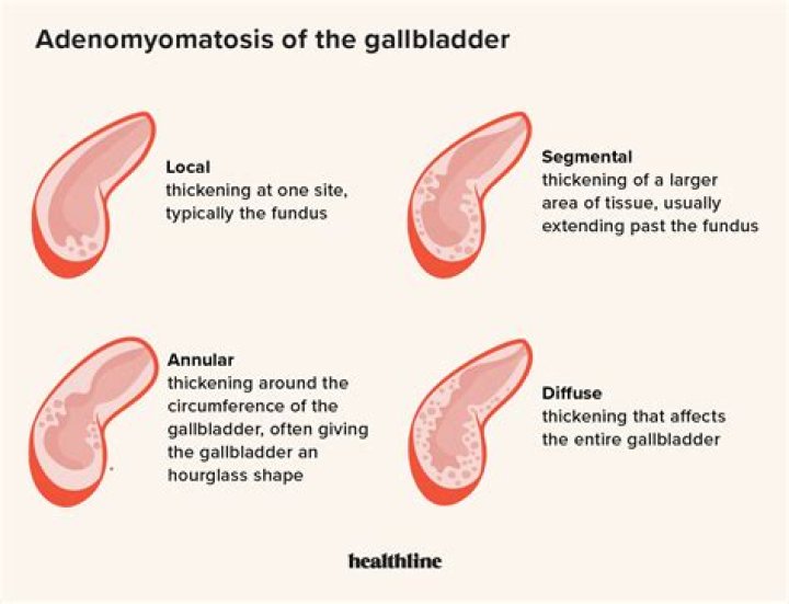 What is gallbladder adenomyosis?