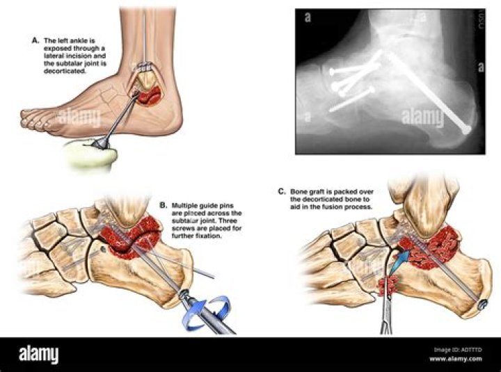 What is subtalar arthrodesis surgery?