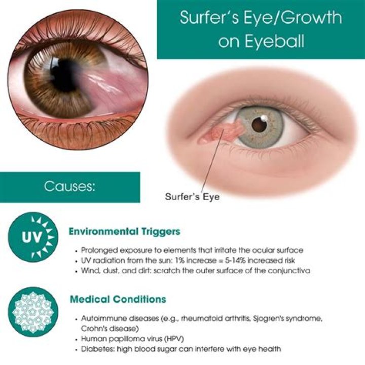 What is the growth in the corner of my eye?