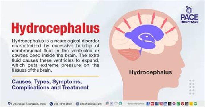 What is the treatment for communicating hydrocephalus?