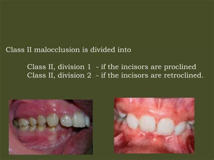 Which profile is usually associated with a Class II malocclusion?